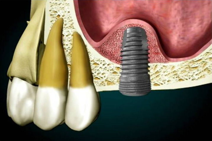 sinus lifting