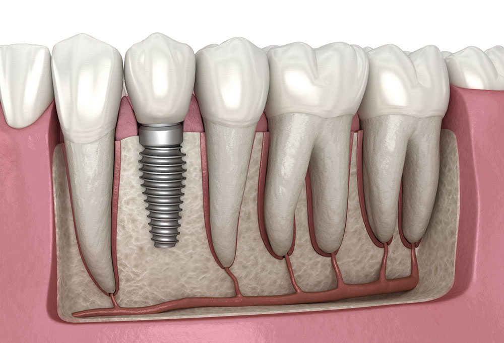 implant fiyatları